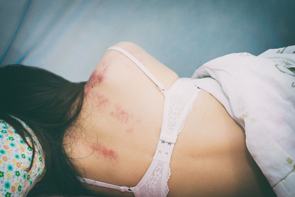 Woman with bruises lying in bed.